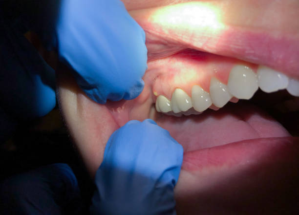 Best Emergency Treatment for Toothache in Berea, SC